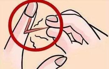 寶寶手指出現(xiàn)倒刺是怎么回事？需要補充維生素嗎？
