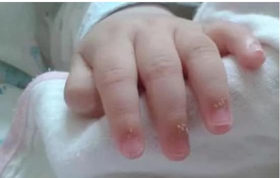 解惑答疑丨寶寶手指長倒刺是因?yàn)槿狈S生素嗎？