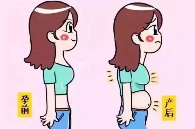 產后大肚腩，小心是腹直肌分離在作怪