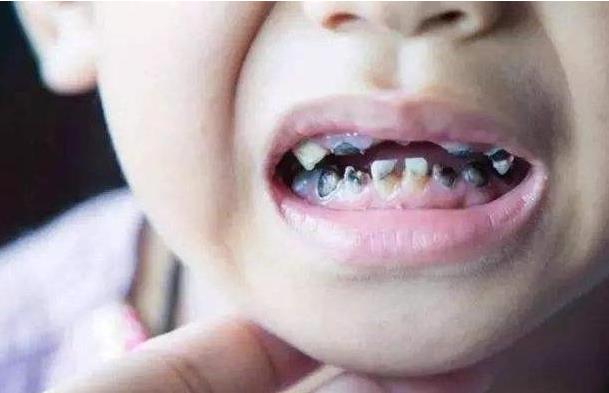 孩子滿口"黑牙"不一定是因?yàn)槭翘枪?/>
      <div   id=