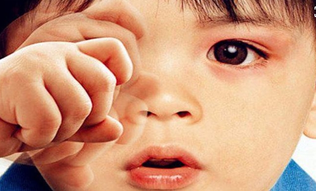小孩頻繁揉眼，小心兒童過敏性結(jié)膜炎來襲