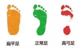 扁平足是有機會矯正的 你給孩子買對鞋了嗎