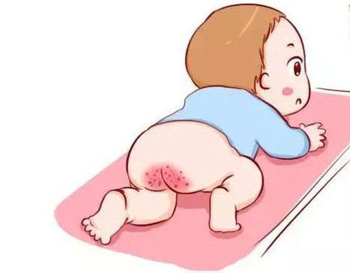面對(duì)寶寶紅屁股，媽媽需要注意這幾件事