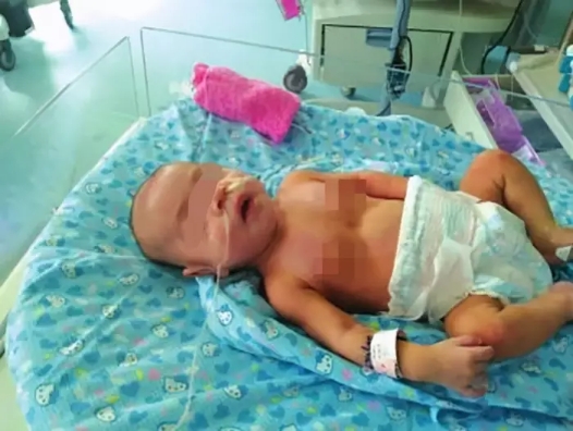 5月大女嬰雙腎長滿結(jié)石，過早添加輔食危害大