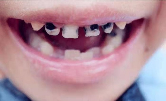 孩子長了“小黑牙”，不僅與糖果有關，還有這些壞習慣