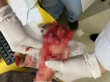 趁媽媽不注意，女孩將手伸進了絞肉機，血的教訓！