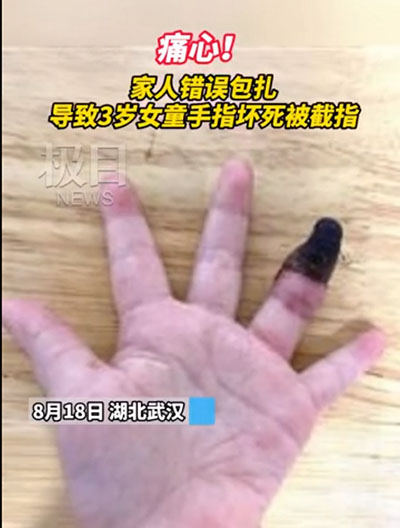 創(chuàng)可貼可別亂用，三歲女童因錯誤包扎手指壞死
