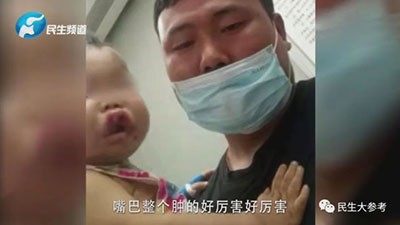 一歲寶寶嘴唇上翻，兩天后被確診白血病