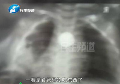 周歲寶寶誤吞異物，導(dǎo)致食道被腐蝕穿孔