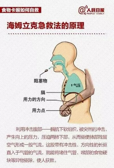 家長必備技能----海姆立克急救法