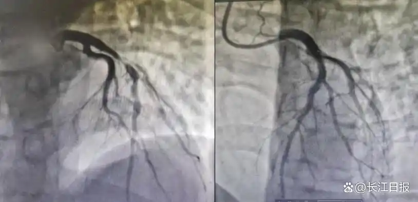 小伙熬夜+酗酒引發(fā)心梗，不良生活習(xí)慣正在摧毀年輕人的心臟